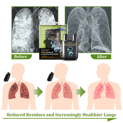 ✅Official Store:Zvoevo® NAC-Enhanced Lung Cleansing Inhaler👨‍⚕️(🫁Sinusitis,cough, wheezing, shortness of breath, sputum, stuffy nose, bronchitis, allergy symptoms, lung discomfort🫁)